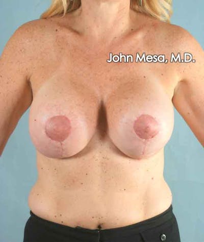 Breast Surgery Revision Before & After Gallery - Patient 6371485 - Image 2