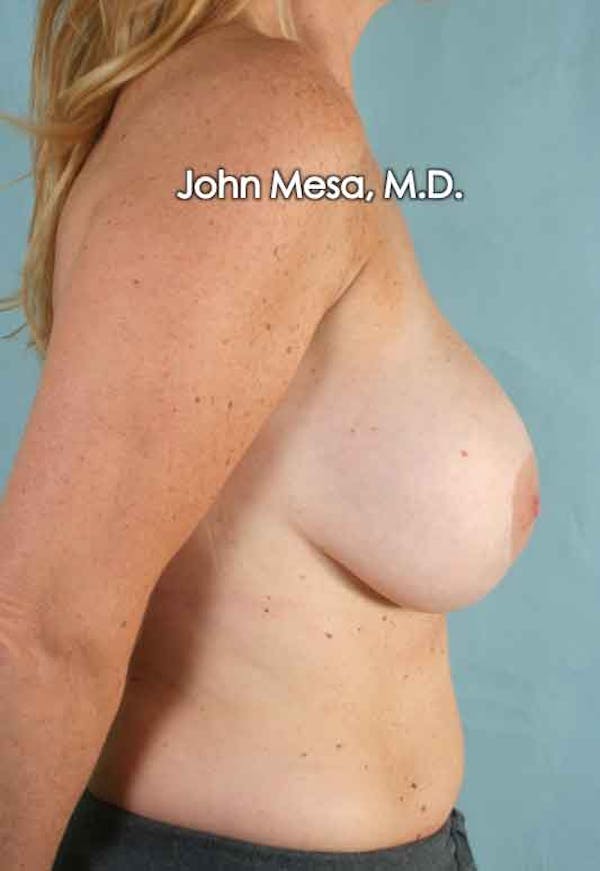 Breast Surgery Revision Before & After Gallery - Patient 6371485 - Image 3