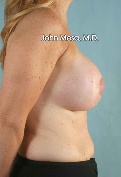 Breast Surgery Revision Before & After Gallery - Patient 6371485 - Image 4