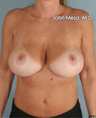 Breast Surgery Revision Before & After Gallery - Patient 6371497 - Image 1