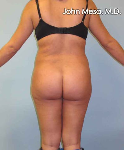 Brazilian Butt Lift Before & After Gallery - Patient 6371487 - Image 1