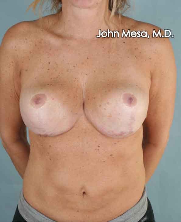 Breast Surgery Revision Before & After Gallery - Patient 6371497 - Image 2