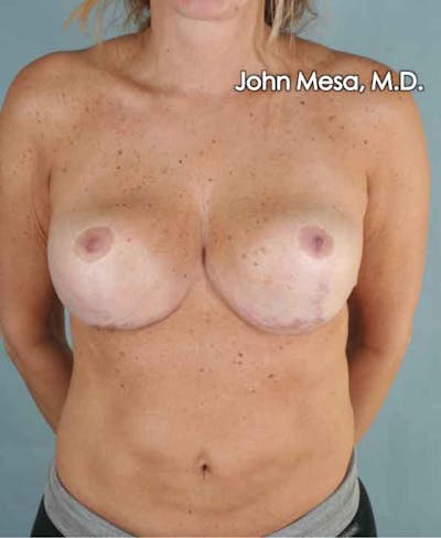 Breast Surgery Revision Gallery - Patient 6371497 - Image 2