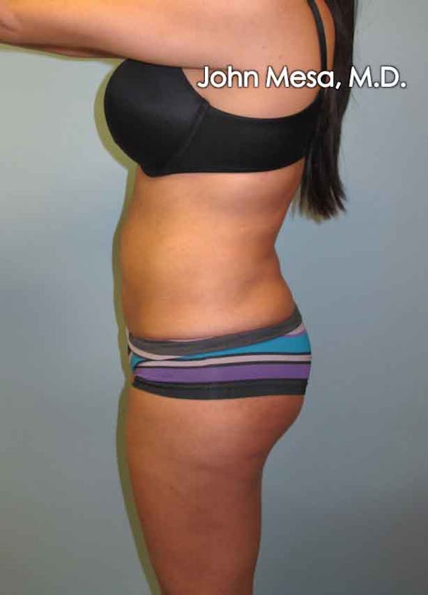 Brazilian Butt Lift Before & After Gallery - Patient 6371487 - Image 3