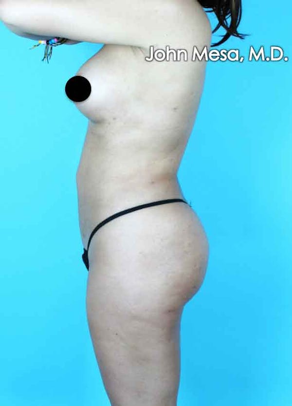 Brazilian Butt Lift Before & After Gallery - Patient 6371487 - Image 4