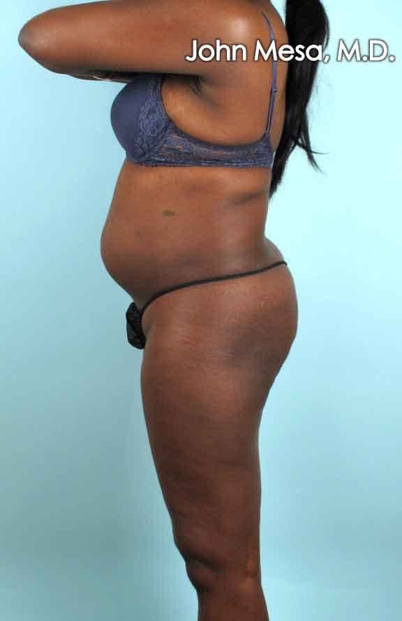 Brazilian Butt Lift Before & After Gallery - Patient 6371499 - Image 1