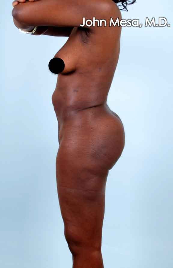 Brazilian Butt Lift Before & After Gallery - Patient 6371499 - Image 2
