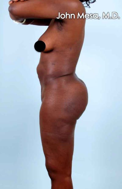 Brazilian Butt Lift Before & After Gallery - Patient 6371499 - Image 2