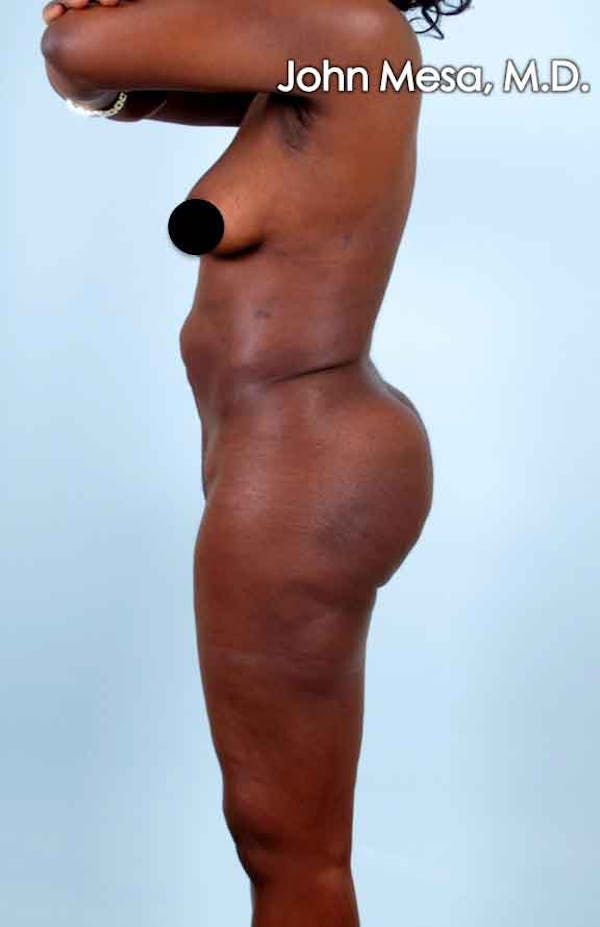 Brazilian Butt Lift Before & After Gallery - Patient 6371499 - Image 2