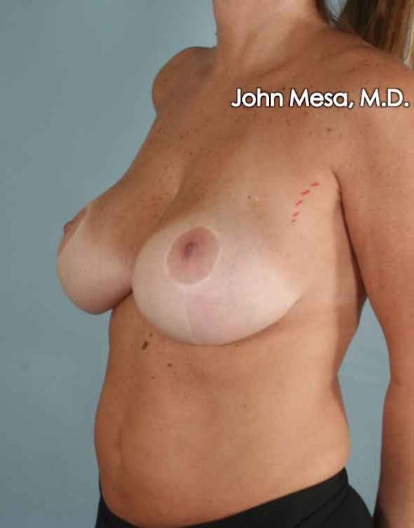 Breast Surgery Revision Gallery - Patient 6371497 - Image 7