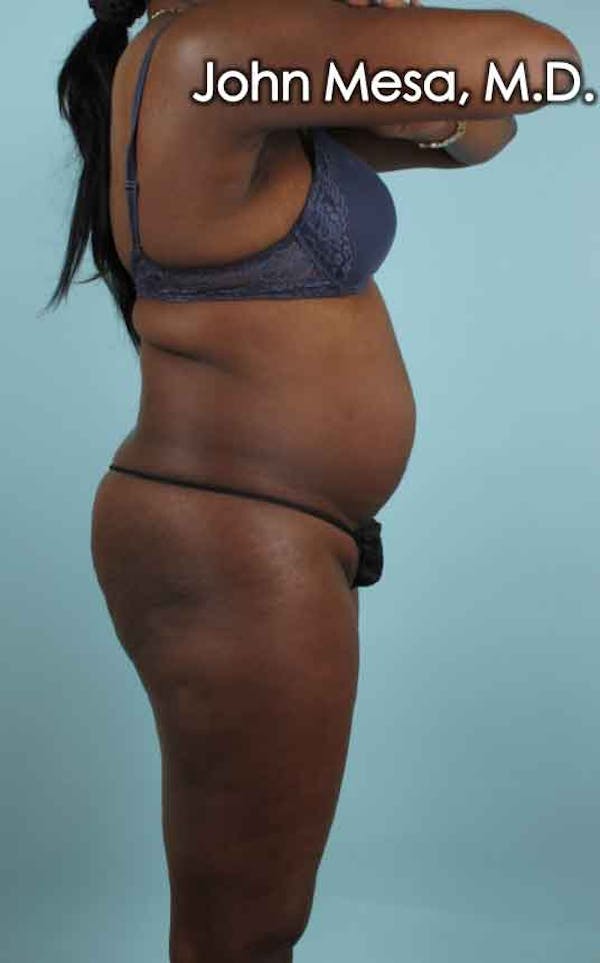 Brazilian Butt Lift Before & After Gallery - Patient 6371499 - Image 3