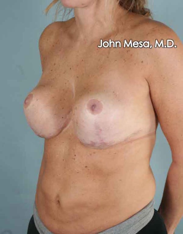Breast Surgery Revision Gallery - Patient 6371497 - Image 8