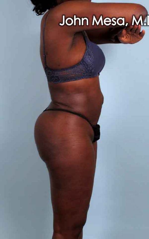 Brazilian Butt Lift Before & After Gallery - Patient 6371499 - Image 4