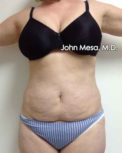 Tummy Tuck (Brazilian Tummy Tuck) Before & After Gallery - Patient 6371502 - Image 1