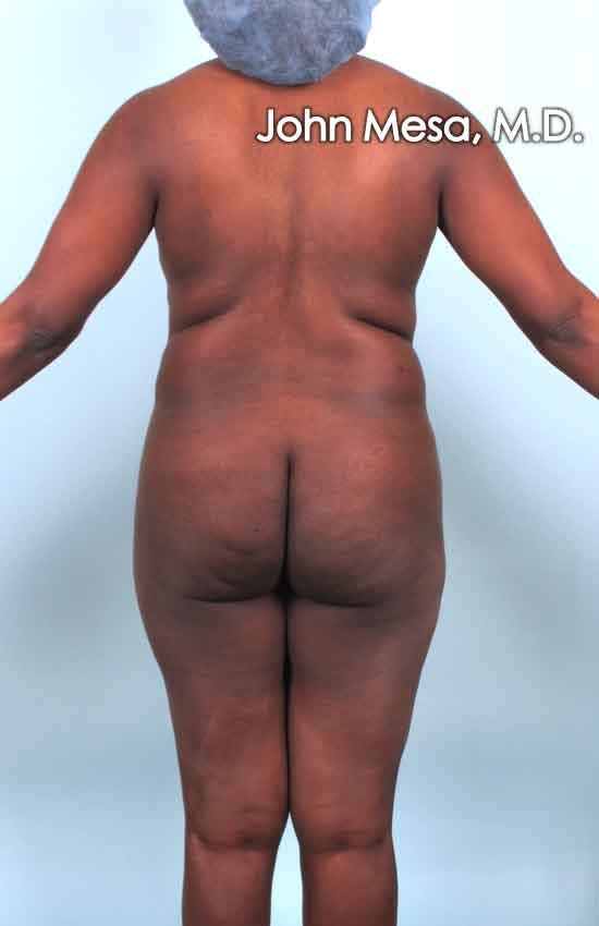 Brazilian Butt Lift Before & After Gallery - Patient 6371503 - Image 1
