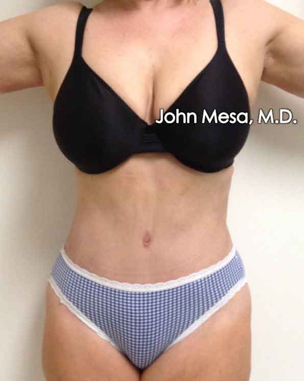 Tummy Tuck