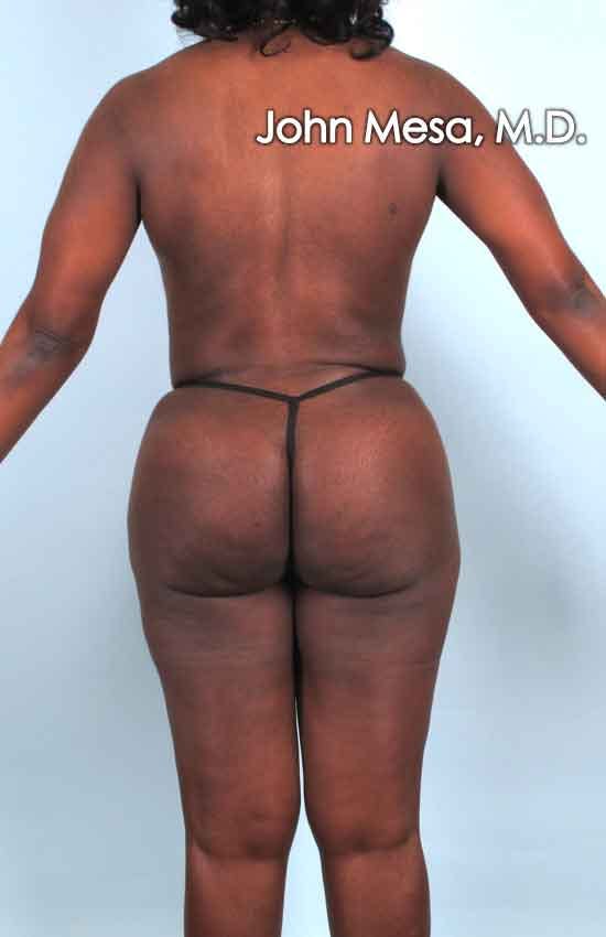 Brazilian Butt Lift Before & After Gallery - Patient 6371503 - Image 2