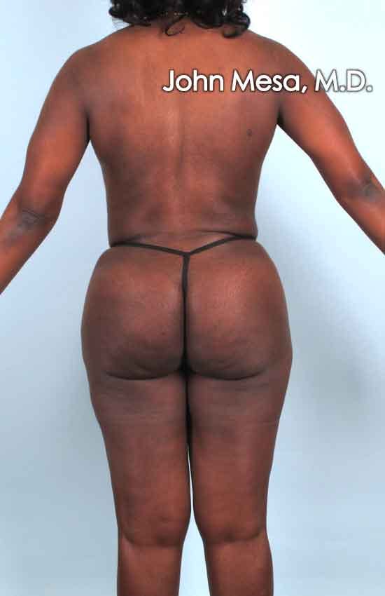 Brazilian Butt Lift Gallery - Patient 6371503 - Image 2