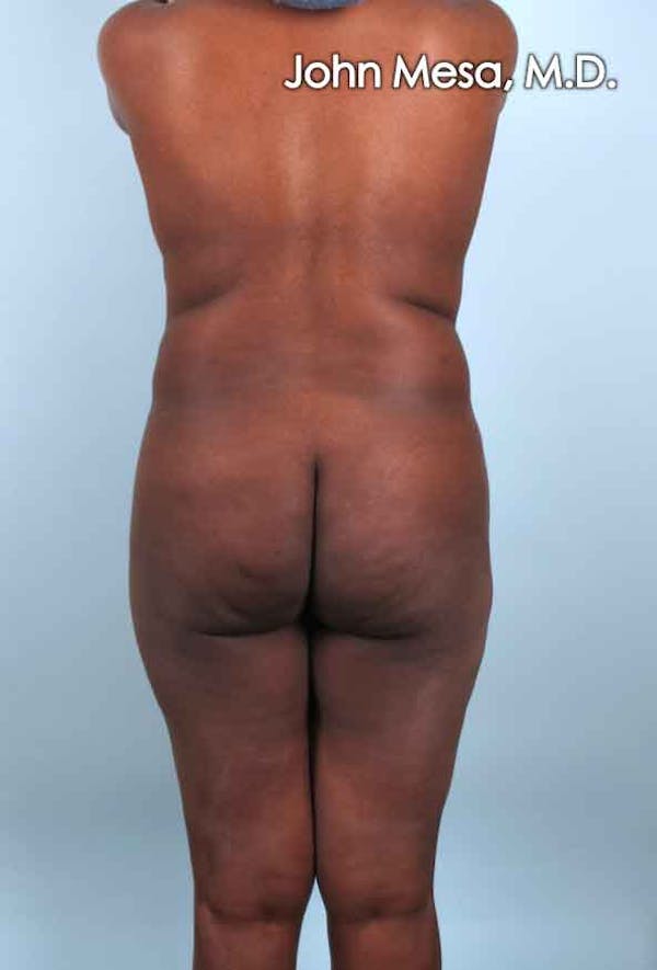 Brazilian Butt Lift Before & After Gallery - Patient 6371503 - Image 5