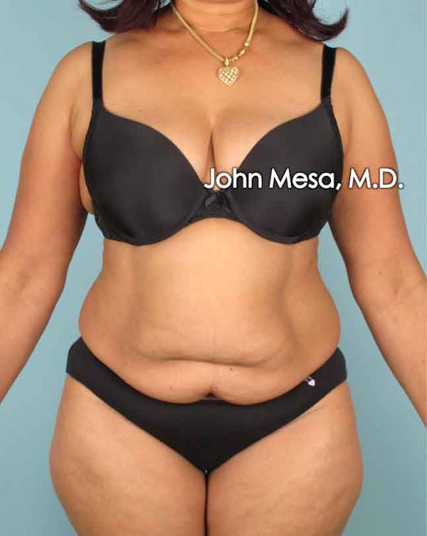 Tummy Tuck (Brazilian Tummy Tuck) Before & After Gallery - Patient 6371505 - Image 1