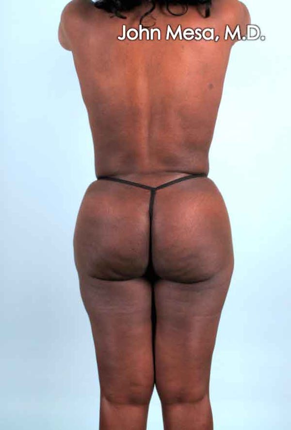 Brazilian Butt Lift Before & After Gallery - Patient 6371503 - Image 6