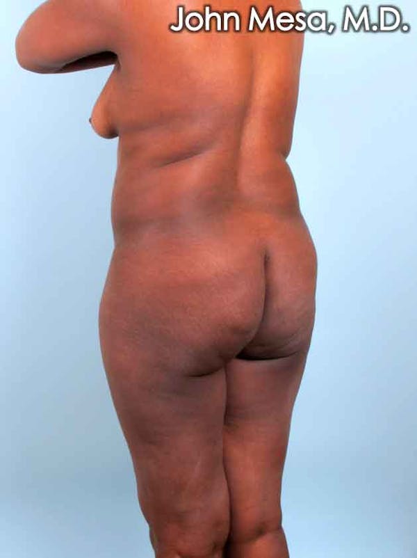 Brazilian Butt Lift Before & After Gallery - Patient 6371503 - Image 7