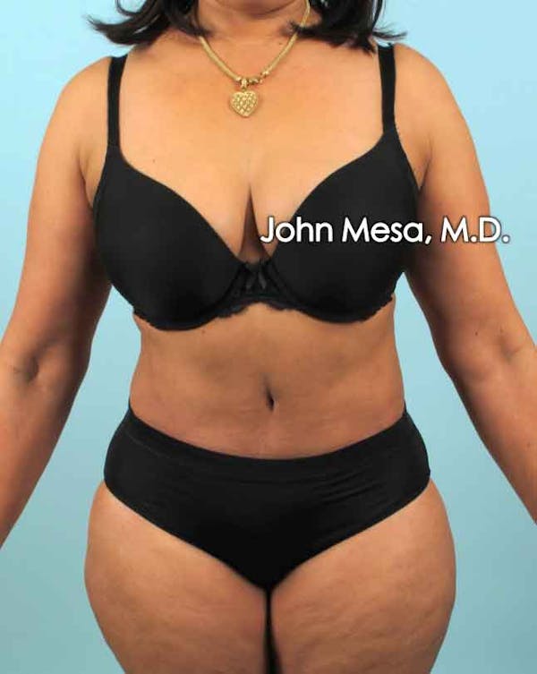 Tummy Tuck (Brazilian Tummy Tuck) Before & After Gallery - Patient 6371505 - Image 2