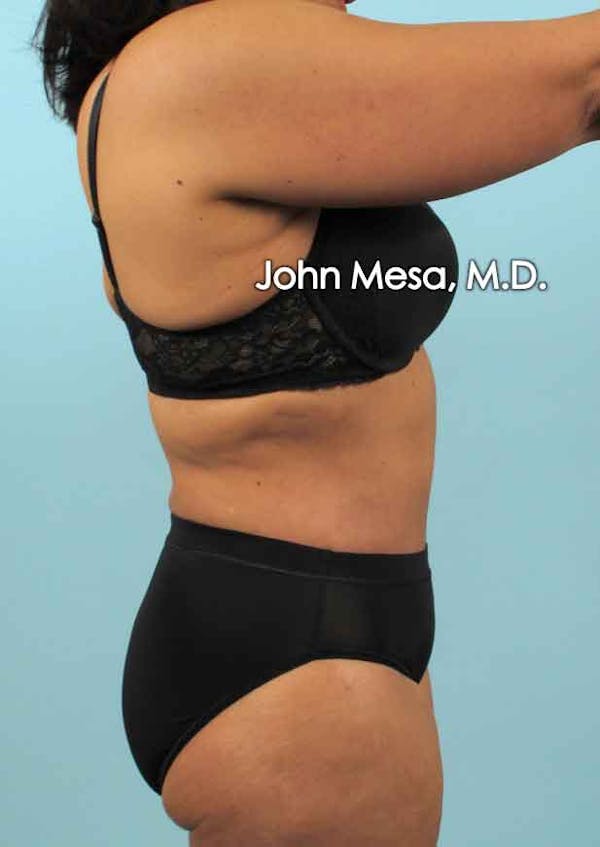 Tummy Tuck (Brazilian Tummy Tuck) Before & After Gallery - Patient 6371505 - Image 4
