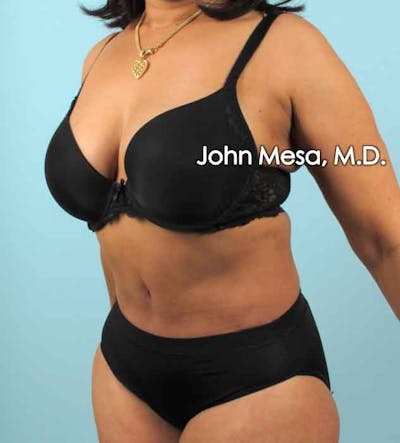Tummy Tuck (Brazilian Tummy Tuck) Before & After Gallery - Patient 6371505 - Image 8