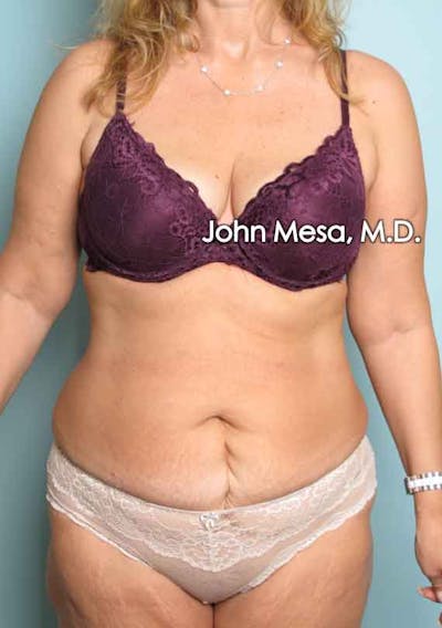 Tummy Tuck (Brazilian Tummy Tuck) Before & After Gallery - Patient 6371506 - Image 1