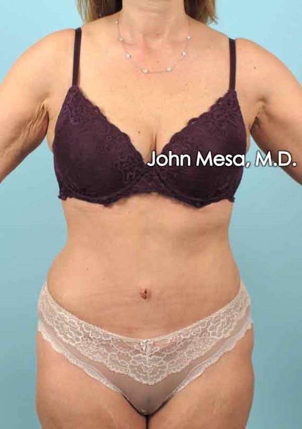 Tummy Tuck (Brazilian Tummy Tuck) Before & After Gallery - Patient 6371506 - Image 2