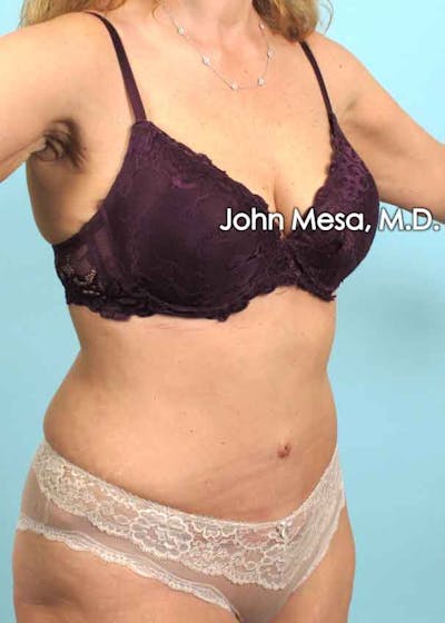 Tummy Tuck (Brazilian Tummy Tuck) Before & After Gallery - Patient 6371506 - Image 4