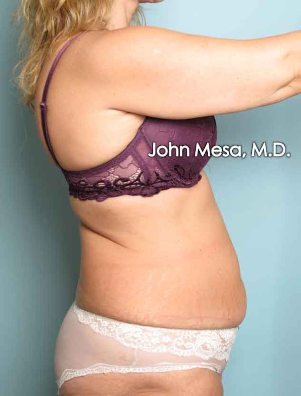 Tummy Tuck (Brazilian Tummy Tuck) Before & After Gallery - Patient 6371506 - Image 5