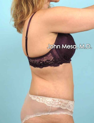 Tummy Tuck (Brazilian Tummy Tuck) Before & After Gallery - Patient 6371506 - Image 6