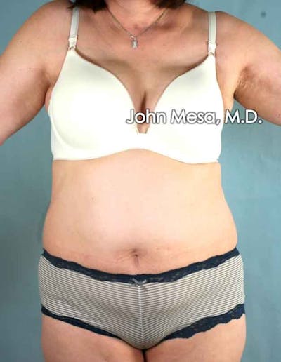 Tummy Tuck (Brazilian Tummy Tuck) Before & After Gallery - Patient 6371508 - Image 1