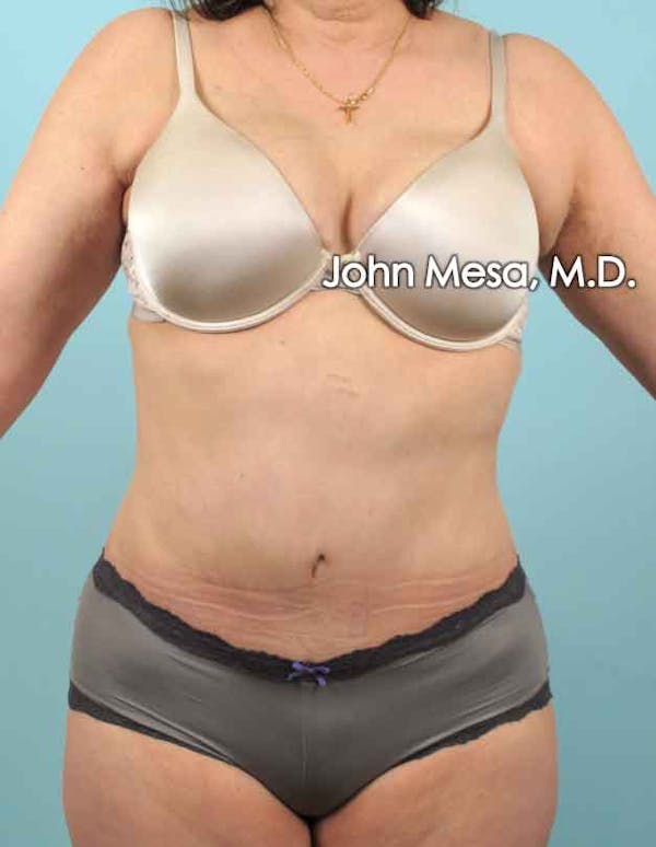 Tummy Tuck (Brazilian Tummy Tuck) Before & After Gallery - Patient 6371508 - Image 2