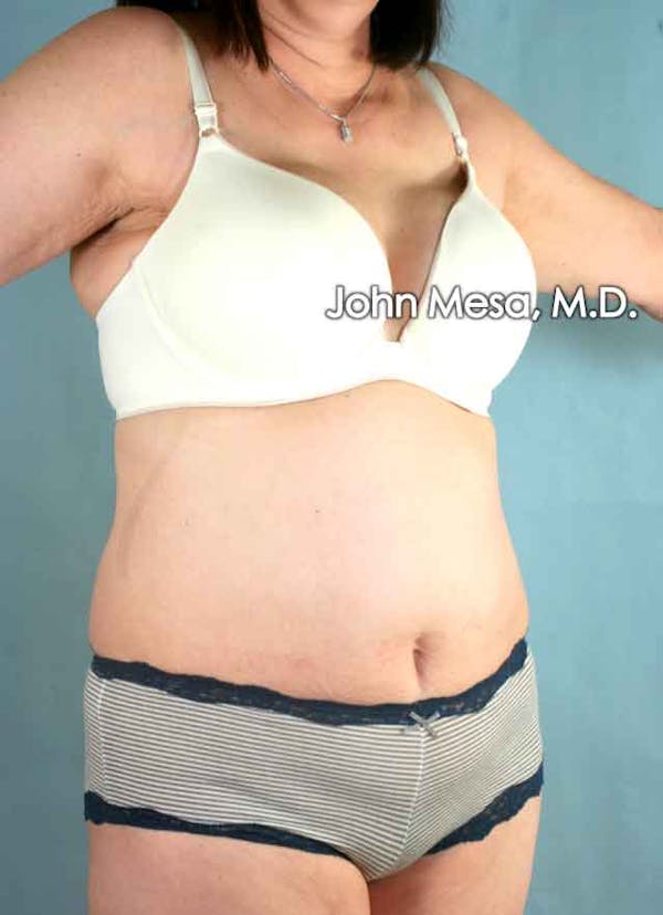 Tummy Tuck (Brazilian Tummy Tuck) Before & After Gallery - Patient 6371508 - Image 3