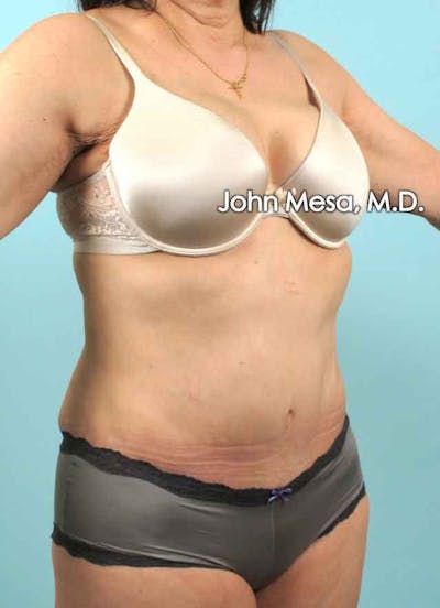 Tummy Tuck (Brazilian Tummy Tuck) Before & After Gallery - Patient 6371508 - Image 4