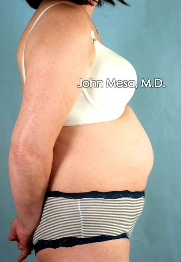 Tummy Tuck (Brazilian Tummy Tuck) Before & After Gallery - Patient 6371508 - Image 5