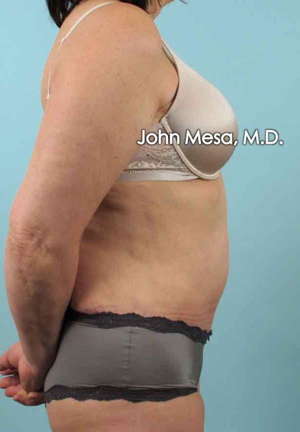 Tummy Tuck (Brazilian Tummy Tuck) Before & After Gallery - Patient 6371508 - Image 6