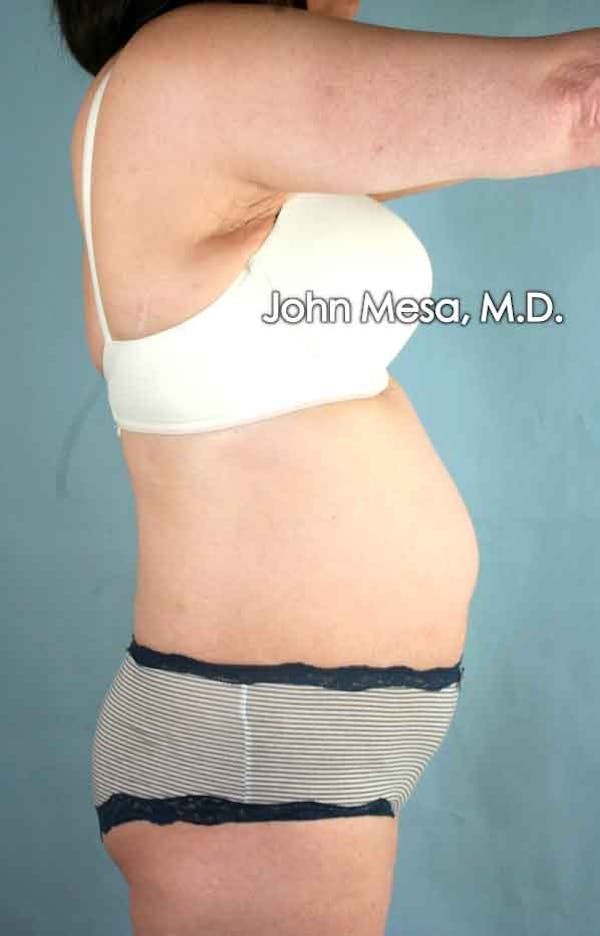 Tummy Tuck (Brazilian Tummy Tuck) Before & After Gallery - Patient 6371508 - Image 7