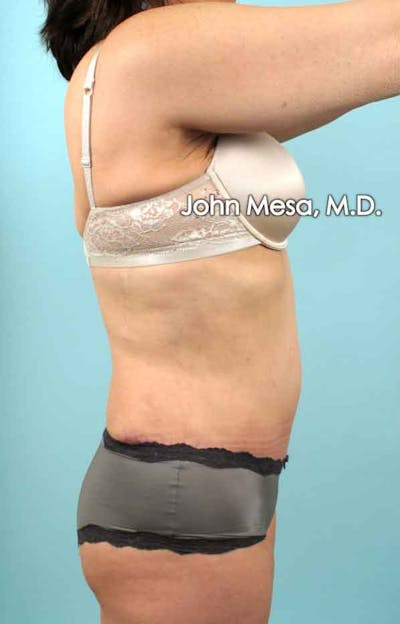 Tummy Tuck (Brazilian Tummy Tuck) Before & After Gallery - Patient 6371508 - Image 8