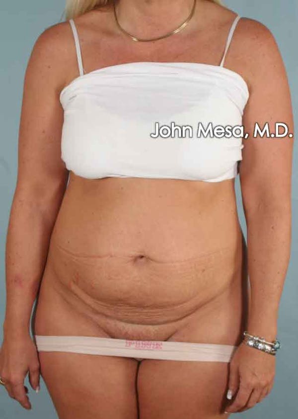 Tummy Tuck (Brazilian Tummy Tuck) Before & After Gallery - Patient 6371510 - Image 1