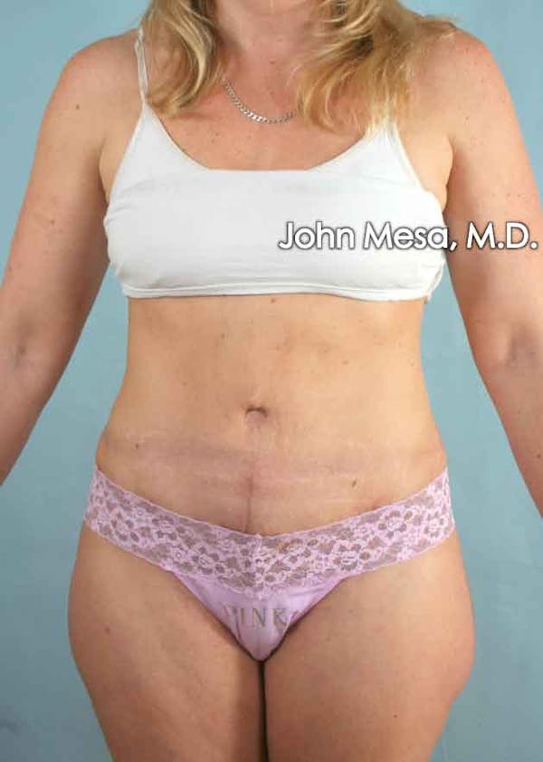 Tummy Tuck (Brazilian Tummy Tuck) Before & After Gallery - Patient 6371510 - Image 2