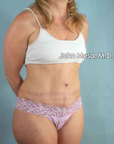 Tummy Tuck (Brazilian Tummy Tuck) Before & After Gallery - Patient 6371510 - Image 4