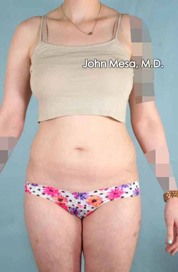 Liposuction Before & After Gallery - Patient 6371511 - Image 1