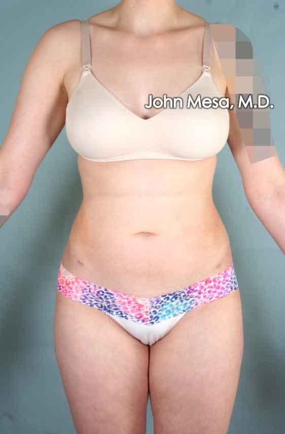 Liposuction Before & After Gallery - Patient 6371511 - Image 2