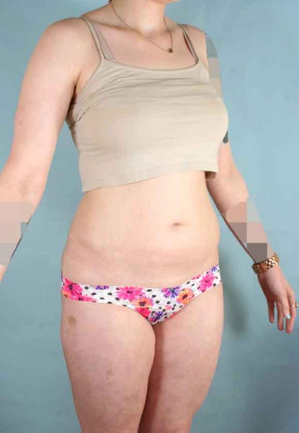 Liposuction Before & After Gallery - Patient 6371511 - Image 3