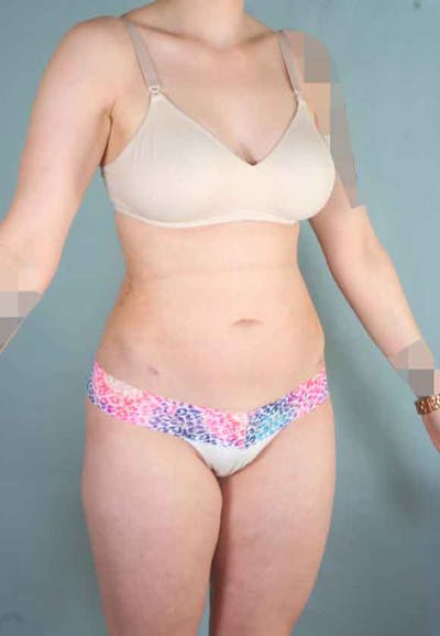 Liposuction Gallery - Patient 6371511 - Image 4