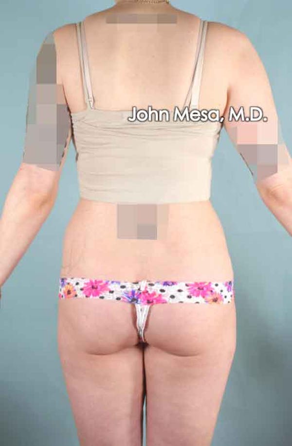 Liposuction Before & After Gallery - Patient 6371511 - Image 5